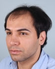 Before Hair Transplant&nbsp;Front